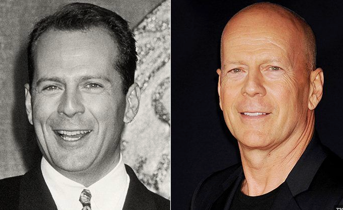 How They Looked: Famous Bald Celebs Before Going Bald